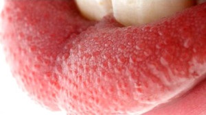 Pattanás nyelv (piros dudorok) fotók, mi van, ha fáj (nyelv) Pattanás nyelv (piros dudorok) fotók, mi van, ha fáj