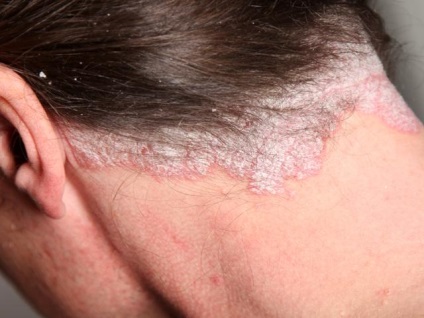 Psoriasis gyermekek kezelése népi jogorvoslati (gyermek) Psoriasis kezelt gyermekeknél népi jogorvoslati