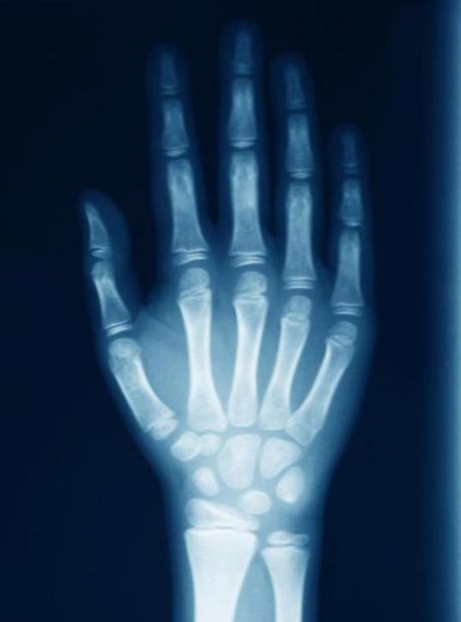 X-sugarak kéz a betegségek és sérülések