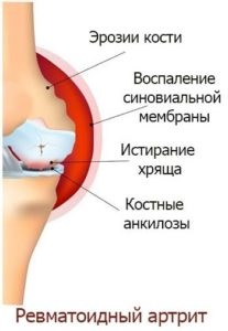 Rheumatoid arthritis a térdízület tüneteket és a kezelés (reumatoid) Rheumatoid arthritis a térd tünetek és a kezelés