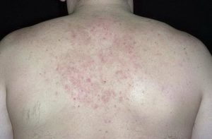 Tünetek, okok és dermatitis hátoldalán