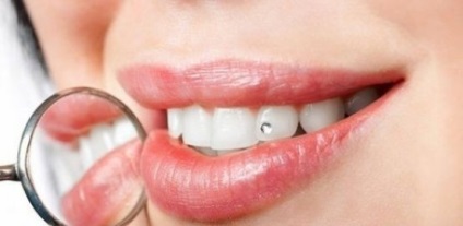 Skys zuba- vagy piercing típusok, rögzítési módszerek, telepítési utasításokat