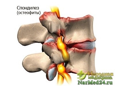 Spondylosis, hogyan lehet megszabadulni a betegség által népi jogorvoslati