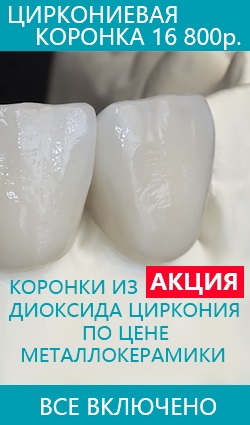 Telepítése kerámia héjak a fogak, az árak Pavlovsky Posad fotók, vélemények, videók, pavlovi