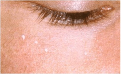 A gyulladás a bőrön, az arc okoz, kezelése és megelőzése