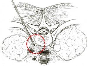 Sebészi kezelése hyperhidrosis módon