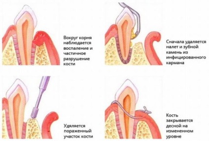 Nekrotizáló fekélyes ínygyulladás klinikai kép, a lehetséges következményeket