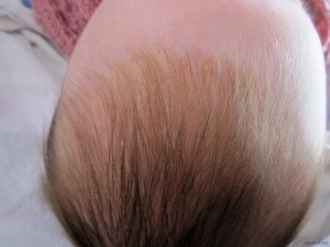 Sárga kéreg fej csecsemők okoz, kezelés