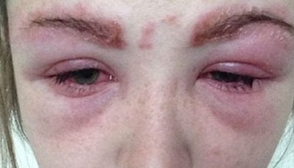 Allergiás a ragasztó szempilla megnyilvánulása, kezelés