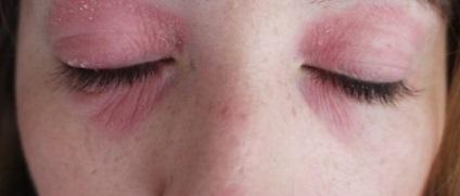 Allergiás a ragasztó szempilla megnyilvánulása, kezelés