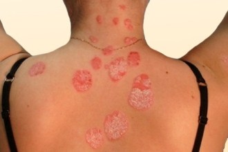 Allergiás a tenger gyümölcsei - tünetek és kezelés (tenger gyümölcsei) Allergiás a tenger gyümölcsei - tünetek és kezelés