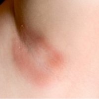 Allergia a hónaljban - szike - orvosi információk és oktatási portál