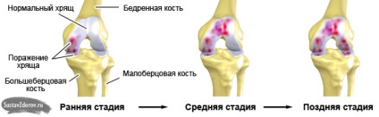 Osteoarthritis a térdízület 3 fok okoz, tünetei, kezelése (fotó)