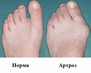 Osteoarthritis metatarsophalangeal együttes az első lábujj kezelés jellemzői