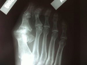 Osteoarthritis metatarsophalangeal együttes az első lábujj adott kezelés (metatarsophalangeal) Osteoarthritis metatarsophalangeal együttes az első lábujj kezelés jellemzői