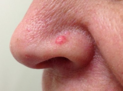 Bazálsejtes karcinóma a bőr, az orr, hogy a sugárkezelés expozíció után