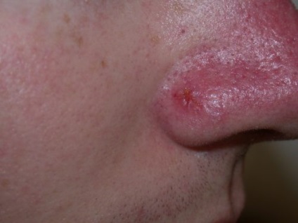 Bazálsejtes karcinóma a bőr, az orr, hogy a sugárkezelés expozíció után