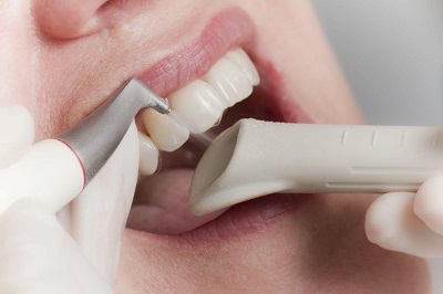 Biztonságos fogfehérítés okozza a fogak, hogy fehérítő káros a fogászatban, barátságos, és megbocsátó