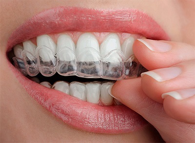 Biztonságos fogfehérítés okozza a fogak, hogy fehérítő káros a fogászatban, barátságos, és megbocsátó