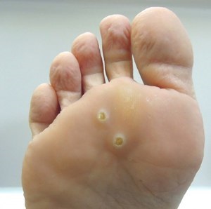 Betegségek a láb gyermekeknél és felnőtteknél