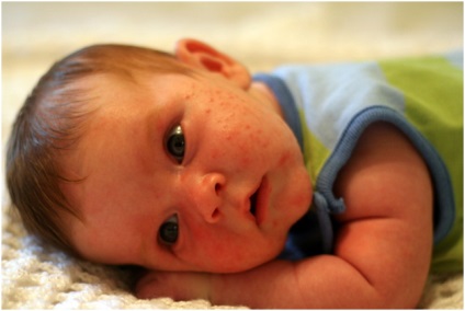 Mi a különbség az akne újszülöttek allergiás bőrkiütés