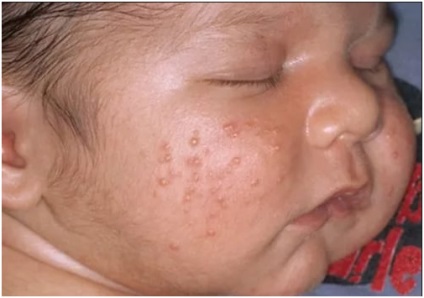 Mi a különbség az akne újszülöttek allergiás bőrkiütés