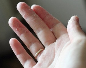 Mi van, ha hámló, száraz és repedezett bőr az ujjakon és a gyermek, hogy mi okozza