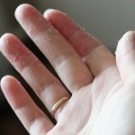 Mi van, ha hámló, száraz és repedezett bőr az ujjakon és a gyermek, hogy mi okozza
