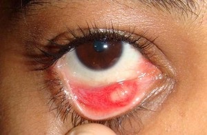 Mi köze a szemgyulladás betegségek okozzák a gyulladást és bőrpír a szem, és a tünetek