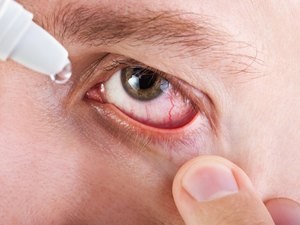 Mi köze a szemgyulladás betegségek okozzák a gyulladást és bőrpír a szem, és a tünetek