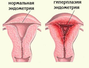 Mi endometrium atrófia
