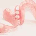 Mi csontpótlás a fogászatban