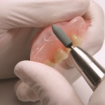 Mi csontpótlás a fogászatban
