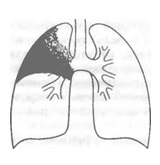 Cirrhosisos tüdő tuberkulózis - azaz