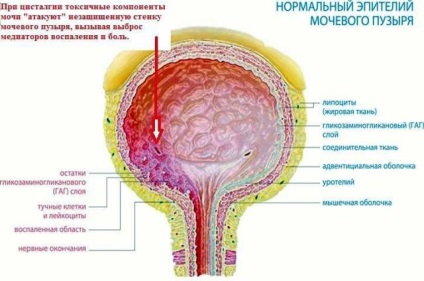 Tsistalgii női okai, tünetei és kezelése cisztás neurózis