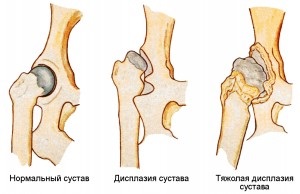 Diszpláziás coxarthrosis hip eredete, a klinikai jellemzői, kezelése