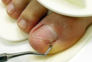 foot nail gomba ecet