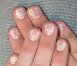 gaidline kezelés gombák nail a kezelés a gombás láb és a körmök