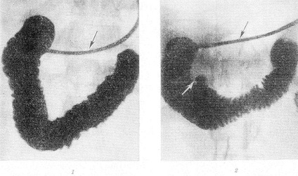Duodenography relaxáció (Vestn rentgenol rádiógramokra) duodenography relaxáció