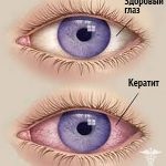 Kettős látás okait és kezelését - otthoni kezelés a szem