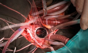 Kéthegyű aortabillentyű tünetek és kezelés