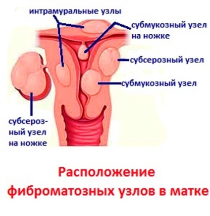 Fibrómás csomópontok és kezelésük