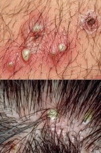 Gennyes pattanások a fejbőrön - Bőrbetegségek