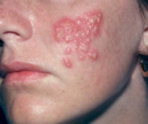 Herpes az arcon (fotó) okai, tünetei és kezelése