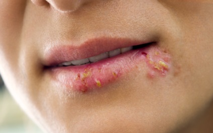 Herpes az arcon (fotó) okai, tünetei és kezelése