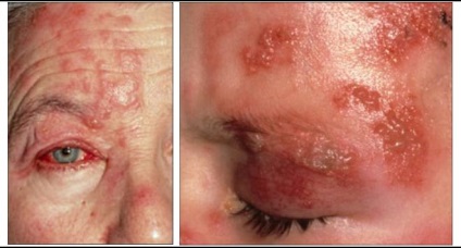 Herpes az arcon - egy fotót a tünetek különböző szakaszaiban
