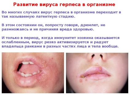 Herpes az arcon - egy fotót a tünetek különböző szakaszaiban