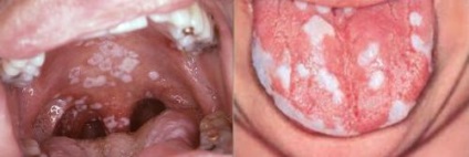 Gombás fertőzés a torokban tüneteket és a kezelés (gombaellenes szerek)