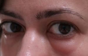 Sérv a szemek alatt okok, tünetek, kezelési módszerek patológia