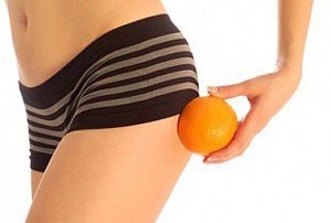 Hogyan lehet megszabadulni a cellulitisz - átfogó megközelítés elleni küzdelem narancshéj